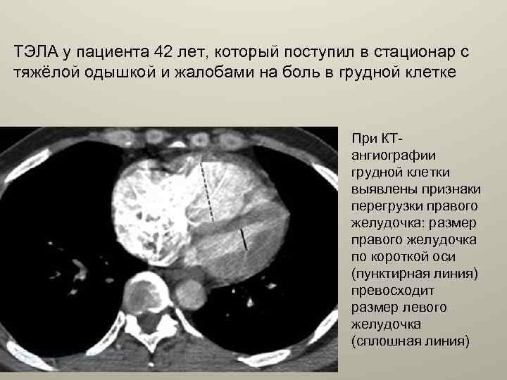 ТЭЛА у пациента 42 лет, который поступил в стационар с тяжёлой одышкой и жалобами