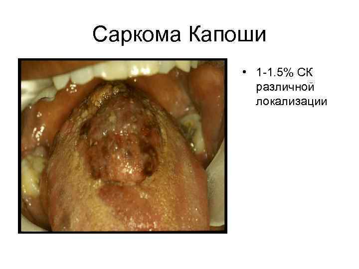 Саркома Капоши • 1 -1. 5% CК различной локализации 