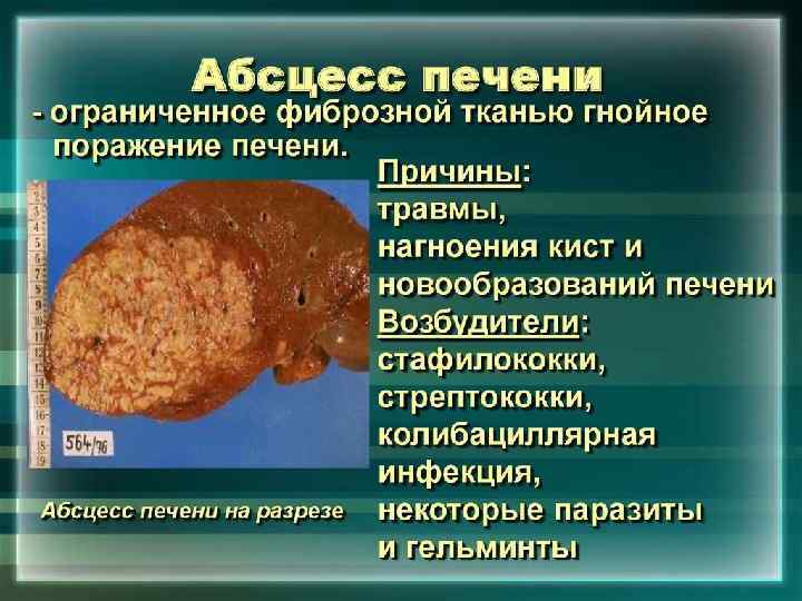 Абсцесс печени 