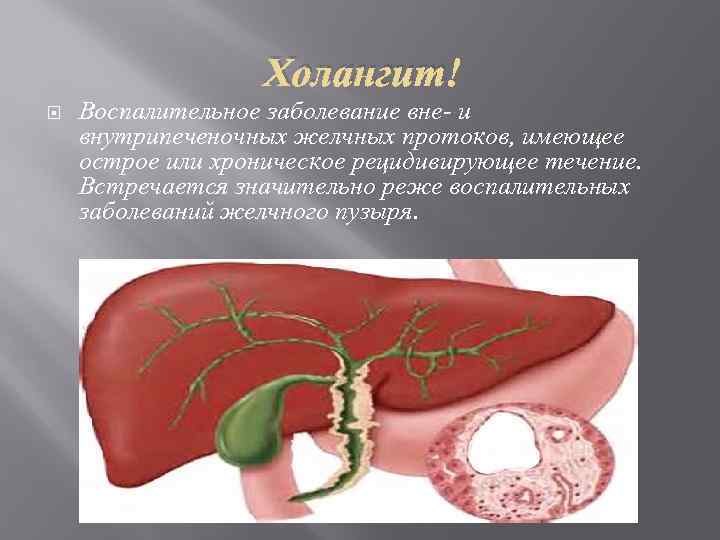 Холангит Воспалительное заболевание вне- и внутрипеченочных желчных протоков, имеющее острое или хроническое рецидивирующее течение.