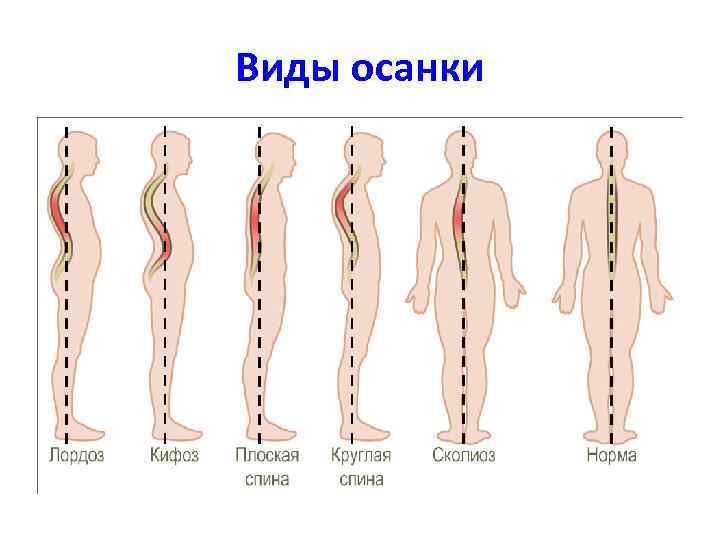 Виды осанки 