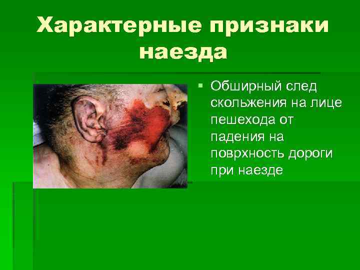Характерные признаки наезда § Обширный след скольжения на лице пешехода от падения на поврхность
