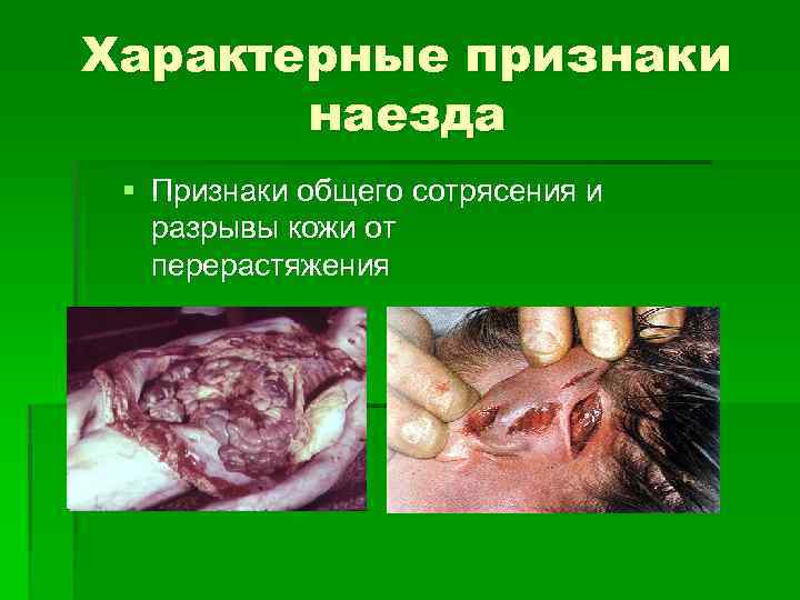 Характерные признаки наезда § Признаки общего сотрясения и разрывы кожи от перерастяжения 