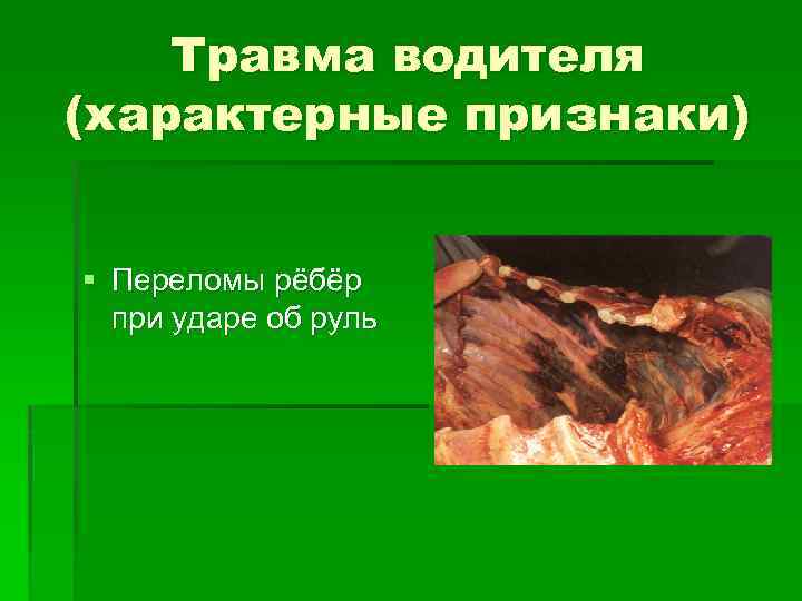 Травма водителя (характерные признаки) § Переломы рёбёр при ударе об руль 