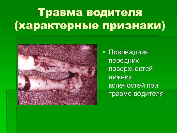 Травма водителя (характерные признаки) § Повреждния передних поверхностей нижних конечостей при травме водителя 