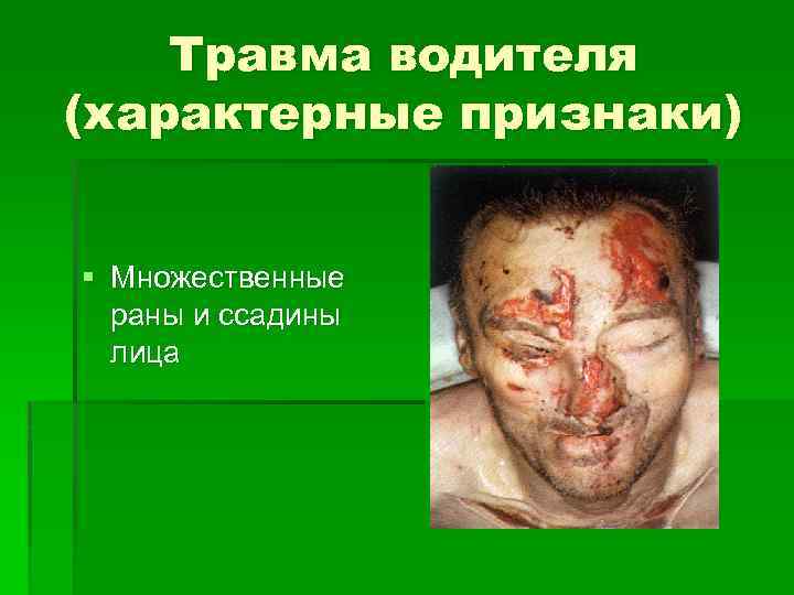 Травма водителя (характерные признаки) § Множественные раны и ссадины лица 