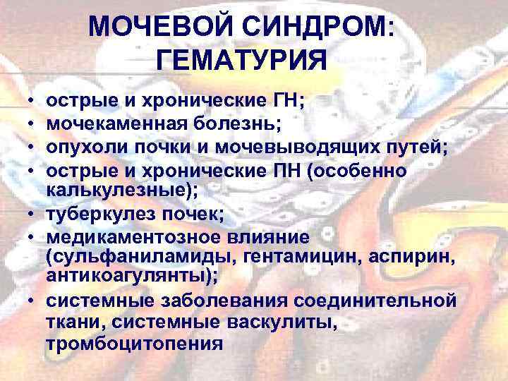 МОЧЕВОЙ СИНДРОМ: ГЕМАТУРИЯ • • острые и хронические ГН; мочекаменная болезнь; опухоли почки и