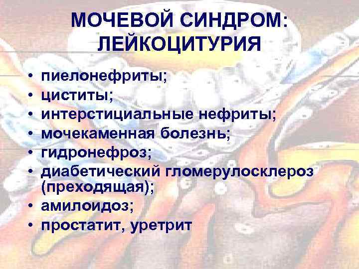 МОЧЕВОЙ СИНДРОМ: ЛЕЙКОЦИТУРИЯ • • • пиелонефриты; циститы; интерстициальные нефриты; мочекаменная болезнь; гидронефроз; диабетический