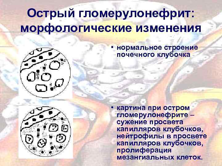 Острый гломерулонефрит: морфологические изменения • нормальное строение почечного клубочка • картина при остром гломерулонефрите