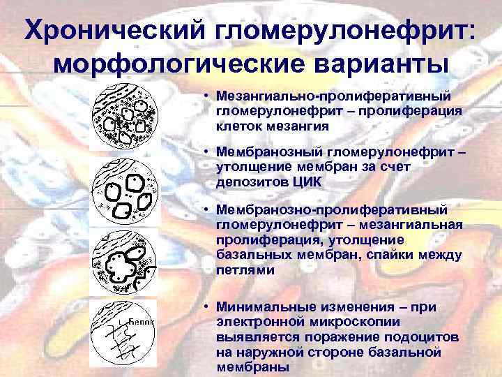 Хронический гломерулонефрит: морфологические варианты • Мезангиально-пролиферативный гломерулонефрит – пролиферация клеток мезангия • Мембранозный гломерулонефрит
