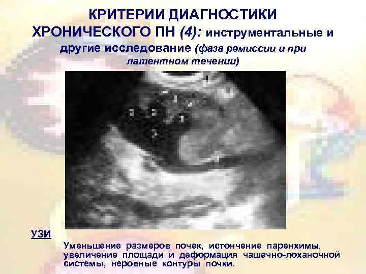 КРИТЕРИИ ДИАГНОСТИКИ ХРОНИЧЕСКОГО ПН (4): инструментальные и другие исследование (фаза ремиссии и при латентном