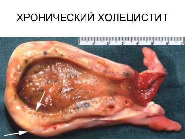 ХРОНИЧЕСКИЙ ХОЛЕЦИСТИТ 