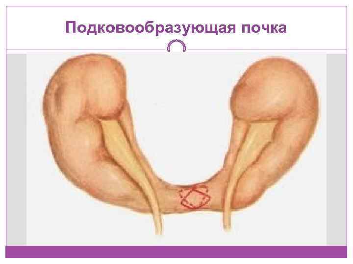 Подковообразующая почка 