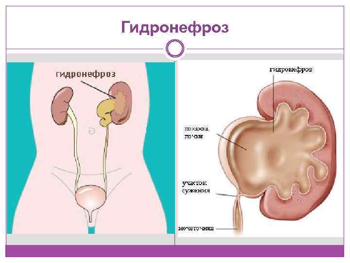 Гидронефроз 