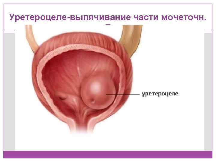 Уретероцеле-выпячивание части мочеточн. 