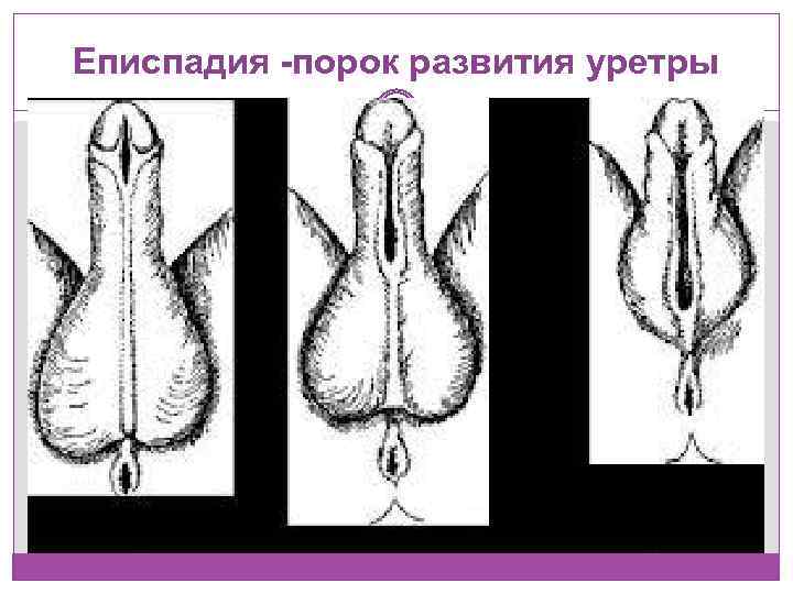 Еписпадия -порок развития уретры 