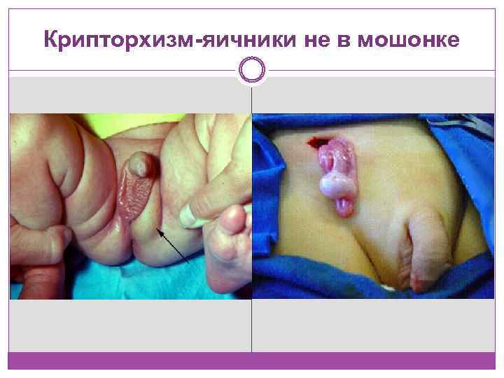 Крипторхизм-яичники не в мошонке 