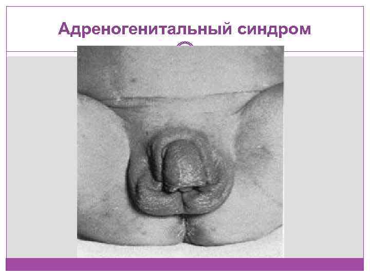 Адреногенитальный синдром 