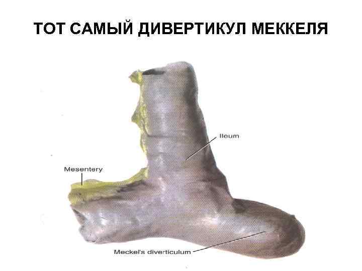 ТОТ САМЫЙ ДИВЕРТИКУЛ МЕККЕЛЯ 