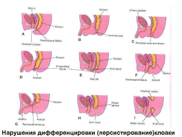 Нарушения дифференцировки (персистирование)клоаки 