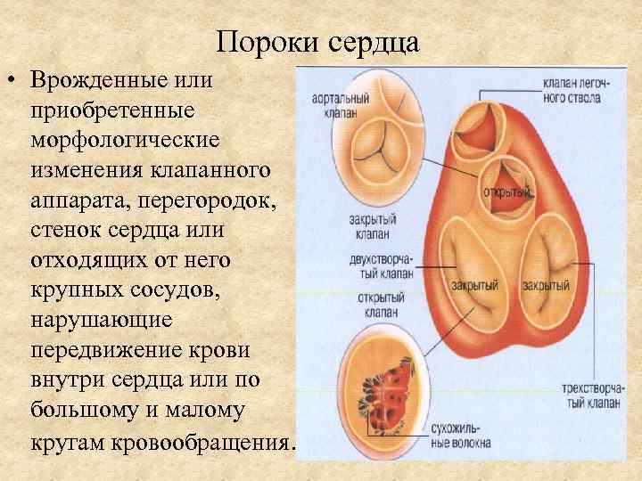 Пороки сердца • Врожденные или приобретенные морфологические изменения клапанного аппарата, перегородок, стенок сердца или