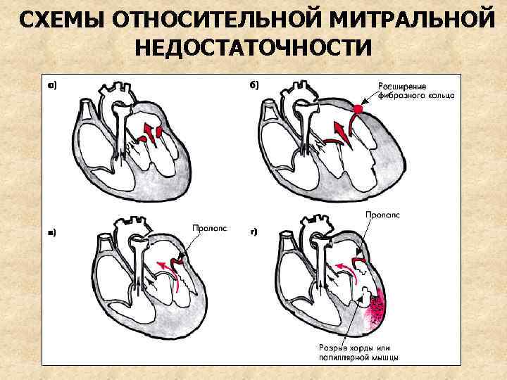 СХЕМЫ ОТНОСИТЕЛЬНОЙ МИТРАЛЬНОЙ НЕДОСТАТОЧНОСТИ 