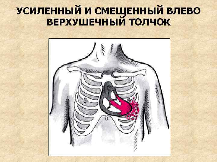 УСИЛЕННЫЙ И СМЕЩЕННЫЙ ВЛЕВО ВЕРХУШЕЧНЫЙ ТОЛЧОК 