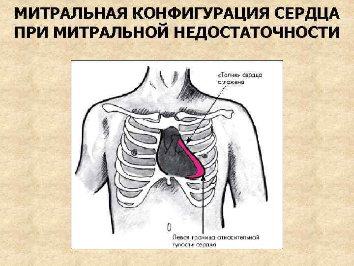 МИТРАЛЬНАЯ КОНФИГУРАЦИЯ СЕРДЦА ПРИ МИТРАЛЬНОЙ НЕДОСТАТОЧНОСТИ 