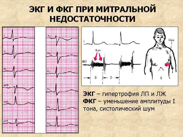 ЭКГ И ФКГ ПРИ МИТРАЛЬНОЙ НЕДОСТАТОЧНОСТИ ЭКГ – гипертрофия ЛП и ЛЖ ФКГ –