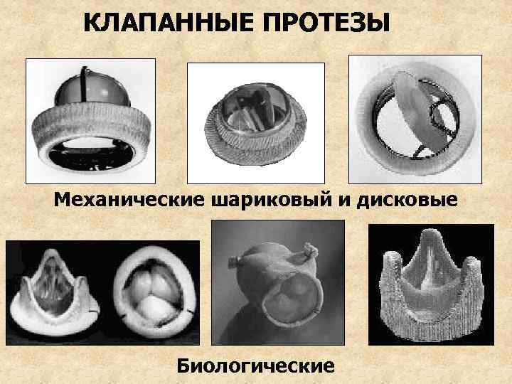 КЛАПАННЫЕ ПРОТЕЗЫ Механические шариковый и дисковые Биологические 