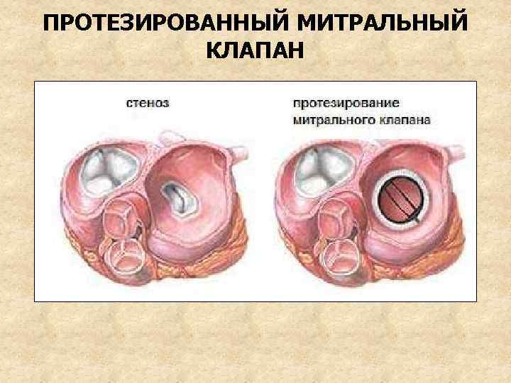 ПРОТЕЗИРОВАННЫЙ МИТРАЛЬНЫЙ КЛАПАН 