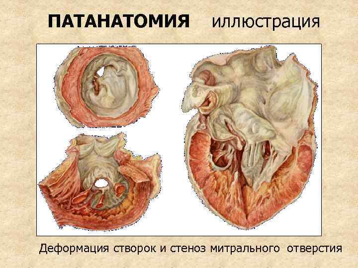 ПАТАНАТОМИЯ иллюстрация Деформация створок и стеноз митрального отверстия 