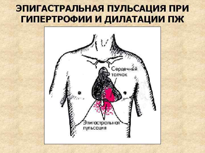 ЭПИГАСТРАЛЬНАЯ ПУЛЬСАЦИЯ ПРИ ГИПЕРТРОФИИ И ДИЛАТАЦИИ ПЖ 