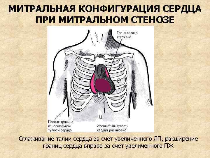 МИТРАЛЬНАЯ КОНФИГУРАЦИЯ СЕРДЦА ПРИ МИТРАЛЬНОМ СТЕНОЗЕ Сглаживание талии сердца за счет увеличенного ЛП, расширение