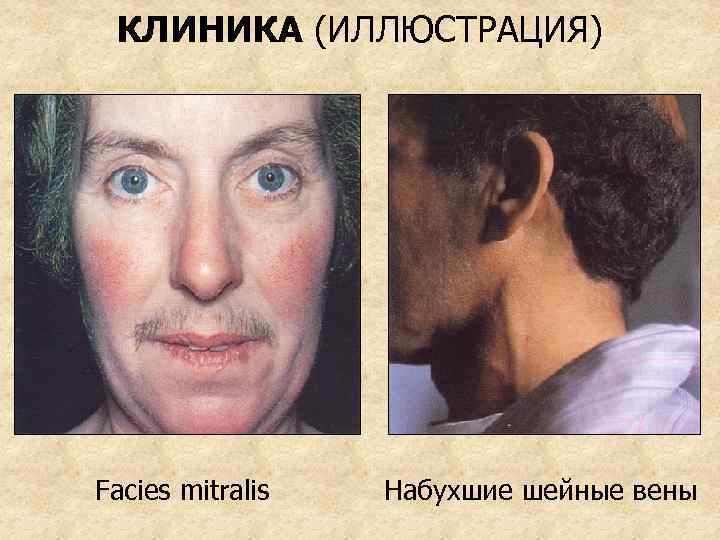 КЛИНИКА (ИЛЛЮСТРАЦИЯ) Facies mitralis Набухшие шейные вены 