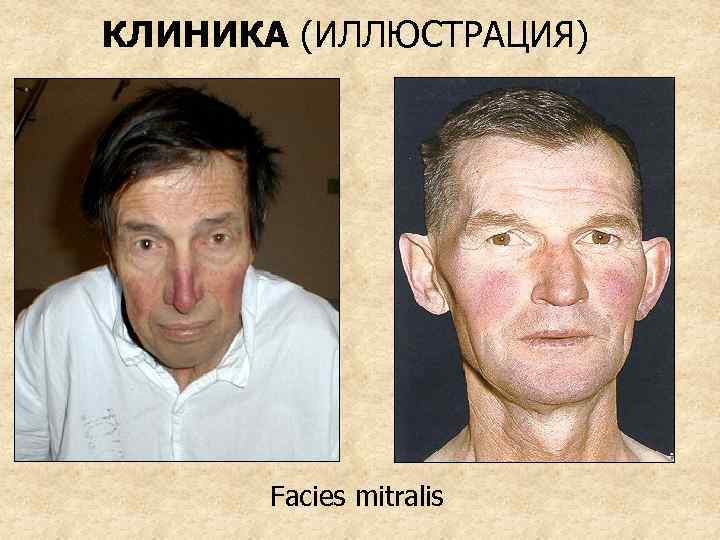 КЛИНИКА (ИЛЛЮСТРАЦИЯ) Facies mitralis 