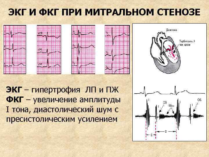 ЭКГ И ФКГ ПРИ МИТРАЛЬНОМ СТЕНОЗЕ ЭКГ – гипертрофия ЛП и ПЖ ФКГ –