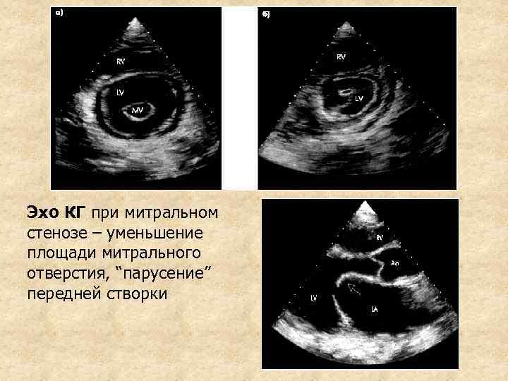 Эхо КГ при митральном стенозе – уменьшение площади митрального отверстия, “парусение” передней створки 