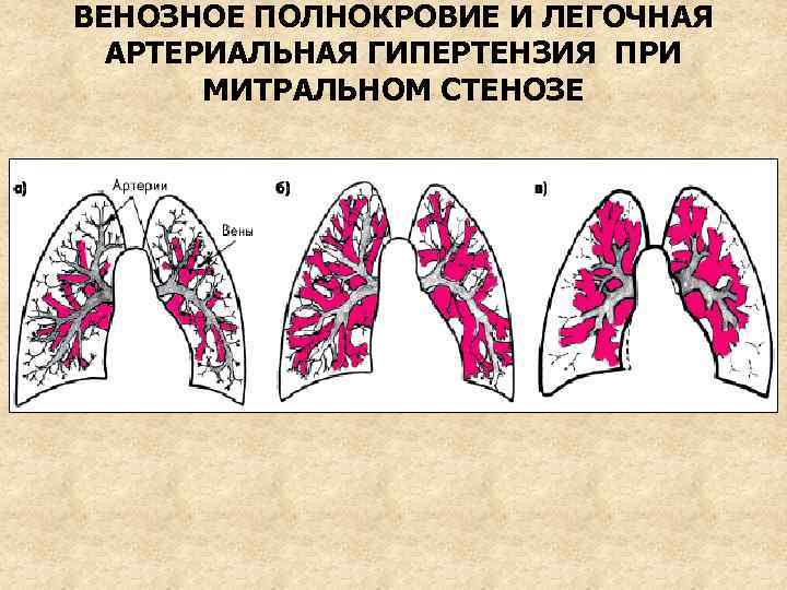 ВЕНОЗНОЕ ПОЛНОКРОВИЕ И ЛЕГОЧНАЯ АРТЕРИАЛЬНАЯ ГИПЕРТЕНЗИЯ ПРИ МИТРАЛЬНОМ СТЕНОЗЕ 