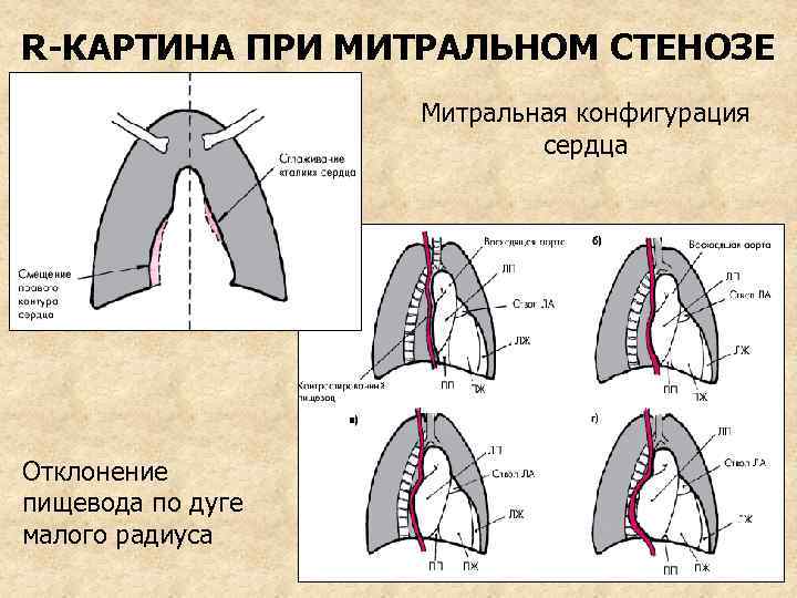 R-КАРТИНА ПРИ МИТРАЛЬНОМ СТЕНОЗЕ Митральная конфигурация сердца Отклонение пищевода по дуге малого радиуса 