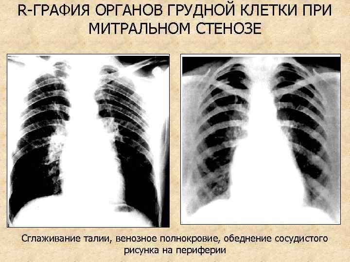 R-ГРАФИЯ ОРГАНОВ ГРУДНОЙ КЛЕТКИ ПРИ МИТРАЛЬНОМ СТЕНОЗЕ Сглаживание талии, венозное полнокровие, обеднение сосудистого рисунка