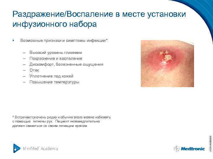 Раздражение/Воспаление в месте установки инфузионного набора • Возможные признаки и симптомы инфекции*: – –