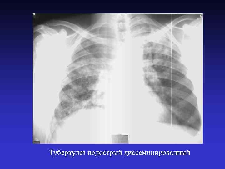 Туберкулез подострый диссеминированный 