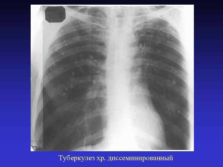 Туберкулез хр. диссеминированный 