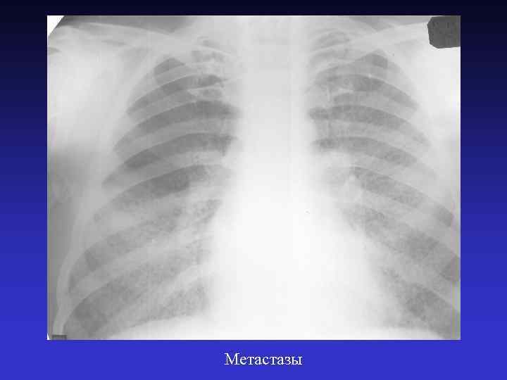 Метастазы 