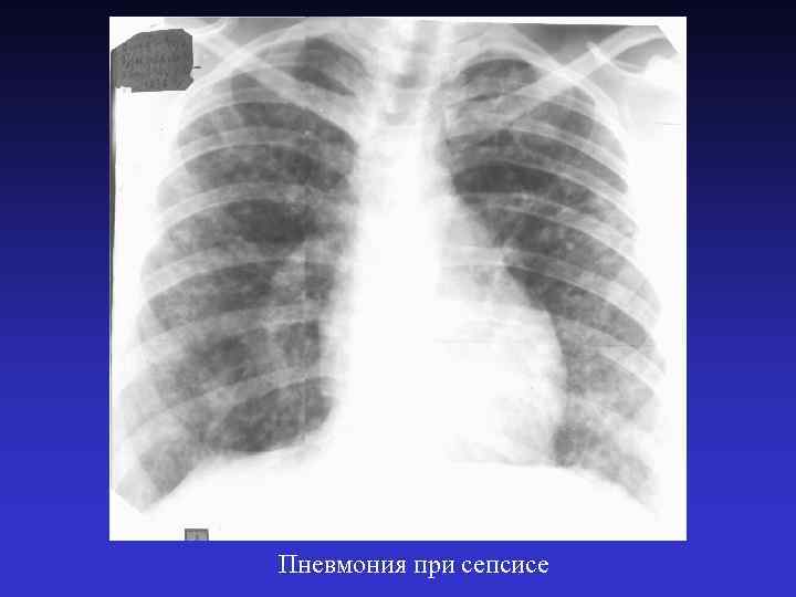 Пневмония при сепсисе 