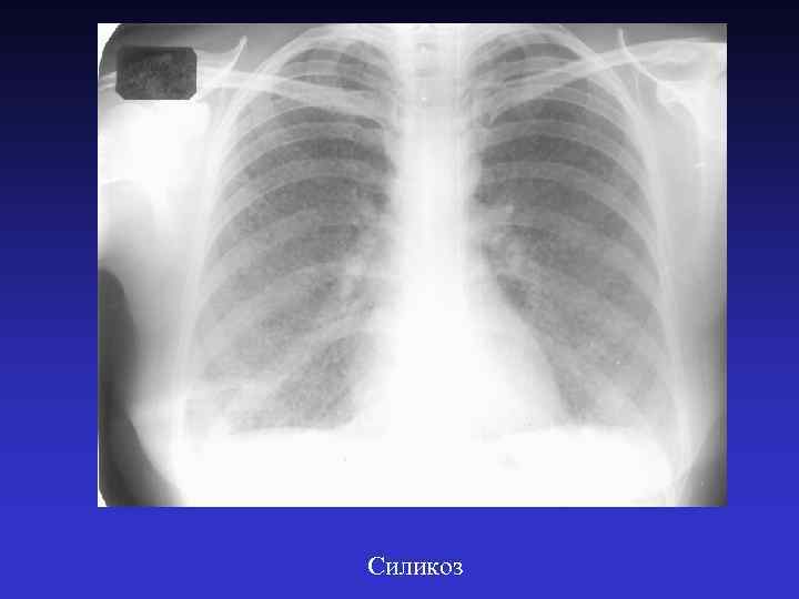 Силикоз 