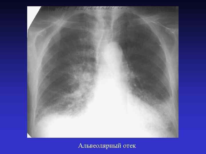Альвеолярный отек 