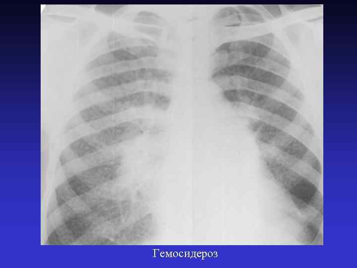 Гемосидероз 