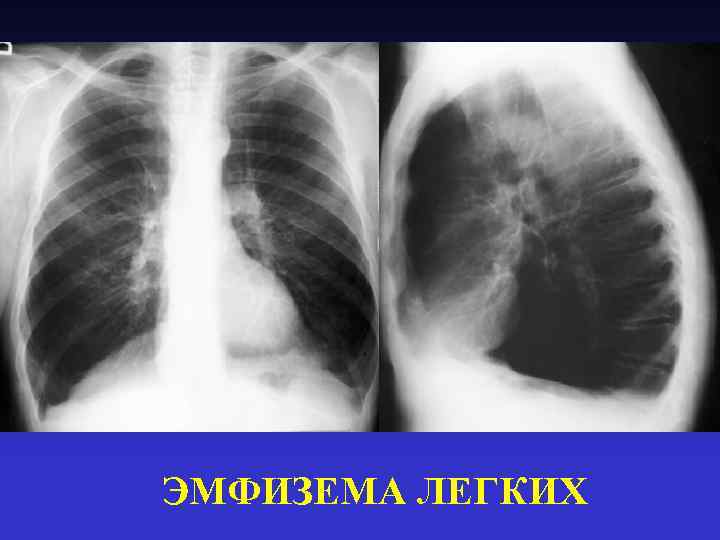 ЭМФИЗЕМА ЛЕГКИХ 